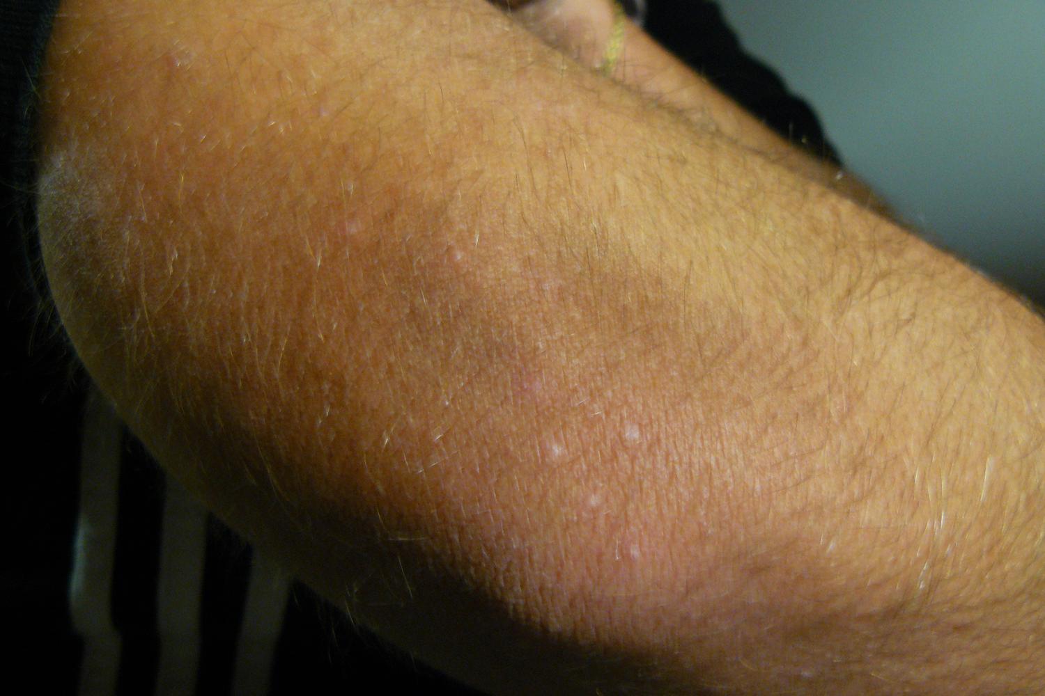 Sur les bras de Lucie, trois semaines après les dernières piqures de punaises, on aperçoit encore des marques blanches.