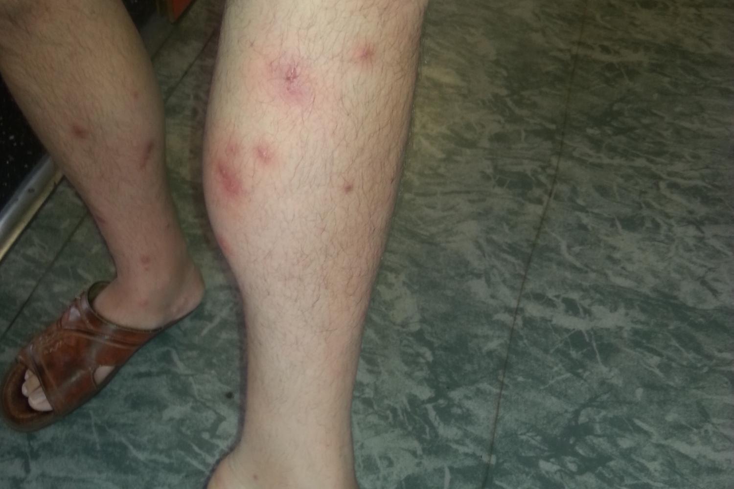 Cet étudiant a fait une réaction allergique violente aux piqures des nuisibles. 